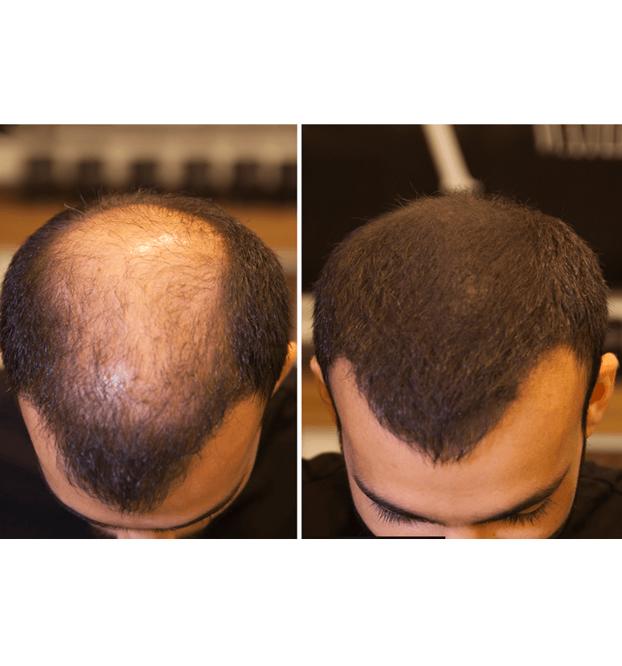 Fixdeep Topical Thickener & Beyaz